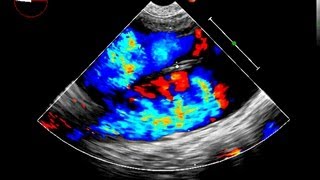 Aortic Dissection Echocardiography [upl. by Ydnelg901]