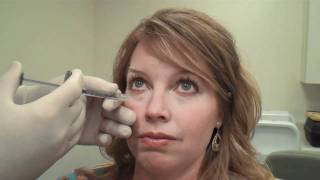 Juvéderm™ Tear Trough Treatment Huntsville Alabama  Dr David L Durst [upl. by Naujad]