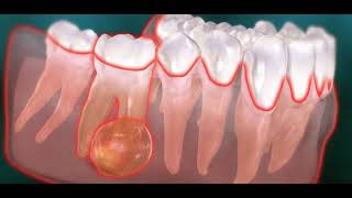 Abcès endodontique dentaire kyste [upl. by Ruff]