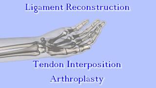 The Anchovy Procedure for Thumb Basal Joint Arthritis [upl. by Whitehouse]