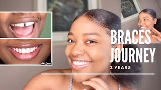 MY BRACES JOURNEY  CLOSING A GAP IN TEETH 🦷 [upl. by Hill782]