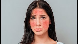 I 7 rimedi naturali contro la rosacea [upl. by Cannice]