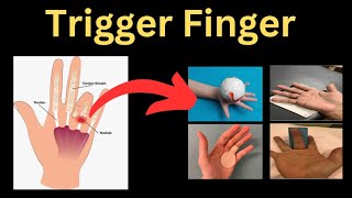 A Complete Guide to Trigger Finger [upl. by Nolos706]