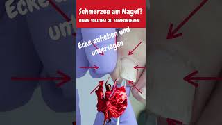 Schmerzen oder ein eingewachsener Nagel Du solltest es mit Tamponade versuchen [upl. by Fernandez]