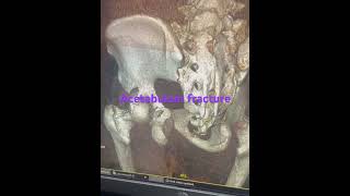 Acetabulum fracture 3D reconstruction fracture trauma [upl. by Eeniffar]