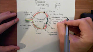 Diabetic Retinopathy Part 2 [upl. by Levon502]