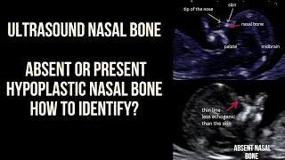 Ultrasound Pregnancy Nasal Bone Absent present or short nasal bone How to identify [upl. by Melania]