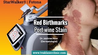 Red Birthmark  PortWine Stain Removal in Delhi  Dr Jaishree Noor  Tvak Laser Clinic [upl. by Arval]