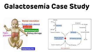 Galactosemia Case Study  Classical Galactosemia  NEXT PG Biochemistry [upl. by Kirtley]