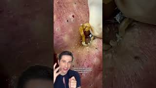 PUTRID EXTRACTIONS dermreacts pimplepopping [upl. by Nylidam]