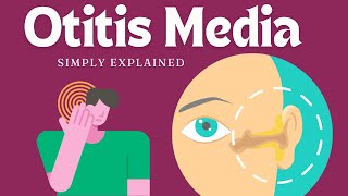 Otitis Media Understanding Ear Infections [upl. by Vinita]