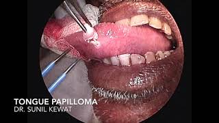 Tongue Papilloma  Treatment  Surgical Excision [upl. by Reifnnej510]