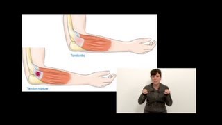 Tendinitis en Músicos ¿Cómo prevenirla [upl. by Adehsor]