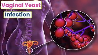 Vaginal Yeast Infections Signs Causes and Treatment [upl. by Namrehs]