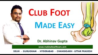 Congenital Talipes Equinovarus Varus CTEV  Club foot  Made easy with Dr Abhinav Gupta [upl. by Graniela]