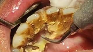 How to remove TARTAR from Teeth  Tartar removal before and after [upl. by Cyrill753]