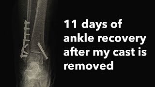 11 days of my recovery progress after a trimalleolar ankle fracture [upl. by Enelec]