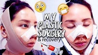 MY PLASTIC SURGERY IN KOREA  VLine amp Rhinoplasty Surgery amp Recovery [upl. by Pierson848]