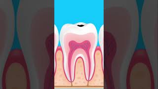 Pulpitis y Necrosis Dental en 1 minuto fyp viralvideo odontologia trending trrndingshorts [upl. by Havard]