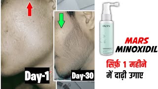 1 month results of minoxidil mars by ghc  mars minoxidil review  minoxidil beard growth beard oil [upl. by Ahtan]