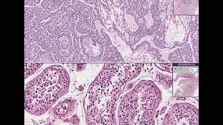 Histopathology TestisEndodermal sinus tumor yolk sac tumo [upl. by Sully]