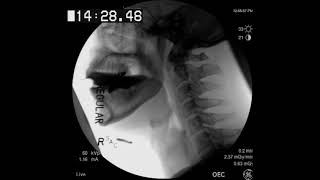 Cricopharyngeal web [upl. by Hendrickson214]