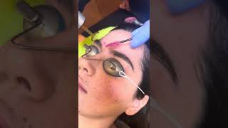 Cosmetic brow tattoo removal at Well Medical arts in Seattle [upl. by Rosemare398]