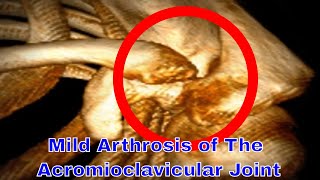 Mild Arthrosis Of The Acromioclavicular Joint [upl. by Neetsuj]