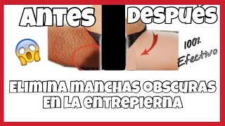 TIPS PARA ELIMINAR MANCHAS OBSCURAS DE LA ENTREPIERNA 100 EFECTIVO [upl. by Alecia176]