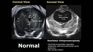 Fetal Brain Ultrasound Normal Vs Abnormal Image Appearances Comparison  Fetal Brain Pathologies USG [upl. by Sydelle]