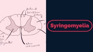 Syringomyelia Rapid Review [upl. by Gunar438]