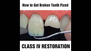 How to fix a chipped cracked or broken tooth MyDentCart  Cracked tooth repair  Broken Tooth [upl. by Caraviello795]