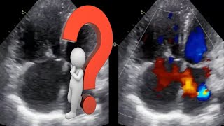 Partial anomalous pulmonary venous return echocardiography PAPVR [upl. by Edmea13]