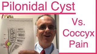 Do you have a PILONIDAL CYST or is it Coccyx Pain Tailbone Pain [upl. by Unhsiv]