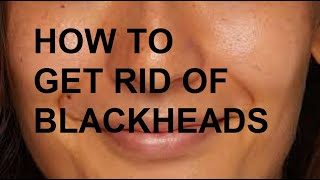 HOW TO GET RID OF BLACKHEADS [upl. by Eatnod]