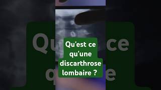 Quest ce que la discarthrose lombaire [upl. by Nnaycart]