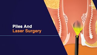 Piles And Laser Surgery  Piles Symptoms and Types  Piles Laser Treatment in Hyderabad [upl. by Yalcrab]