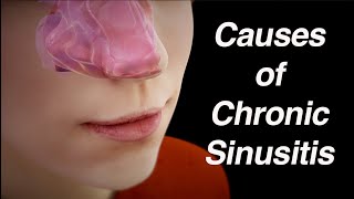 Causes of Chronic Sinusitis Anatomic Factors Biofilm Abnormal Microbiome [upl. by Ahsas]