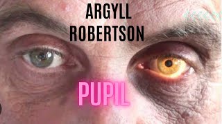 Argyll Robertson Pupil [upl. by Galvan880]