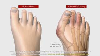 What Is Lapiplasty® 3D Bunion Correction®  All About The Lapiplasty® Procedure [upl. by Nedac]