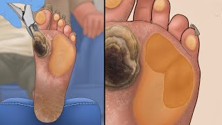 ASMR Treatment of severely hard and cracked feet  Calluses Plantar Warts Corn [upl. by Ellehcim]