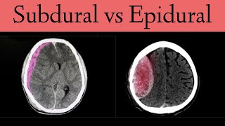 Subdural vs Epidural HematomaHemorrhage CT Scan Findings [upl. by Notseh658]