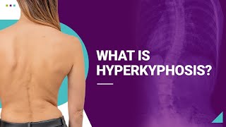 What is Hyperkyphosis [upl. by Kata]