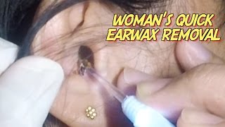 Womans Quick Earwax Removal [upl. by Oigaib]