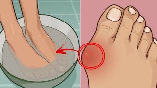 Home Remedies for Bunions  5 Incredible Natural Cure For Bunions [upl. by Enahpets]