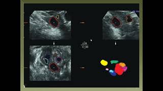 Antral follicle count [upl. by Irwinn]