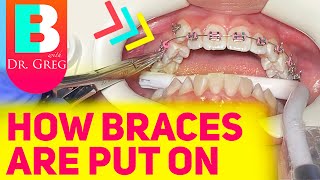 Getting Braces 101  Putting Braces On [upl. by Pansie]