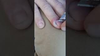 Infected cuticle on finger  Paronychia [upl. by Spevek]