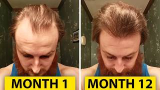 How To Reverse Hair Loss In 12 Months [upl. by Silverstein769]