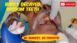 No Forceps No Surgery Elevator Extraction SOS Wisdom Teeth Emergency wisdomteeth dental [upl. by Dyl]